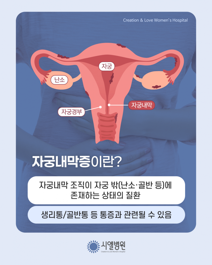 생리통의 원인, 단순한 통증이 아닌 자궁내막증일 수 있다? - 시엘병원 오성택원장 첨부파일 : 1773376686.png